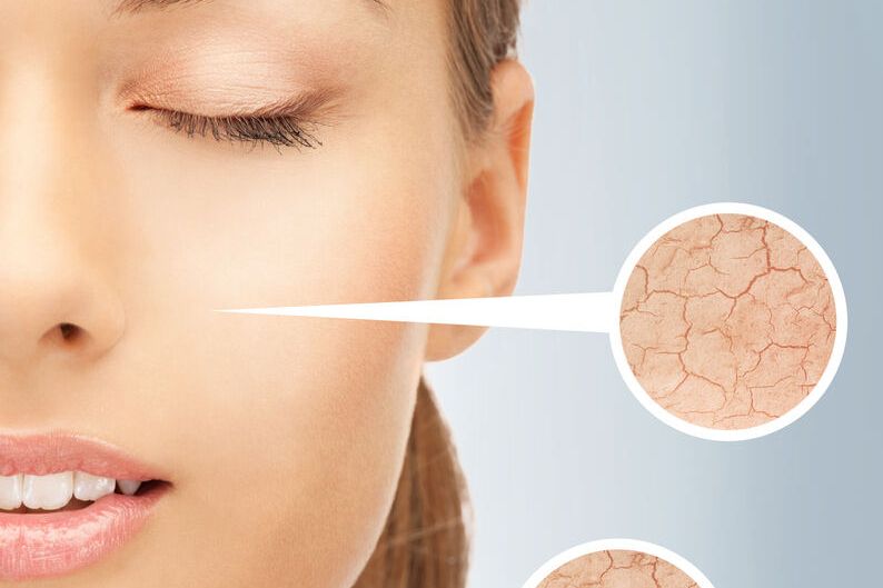 Seborrheic dermatitis