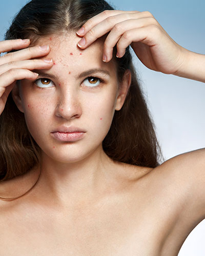 Brown spots & sun damage