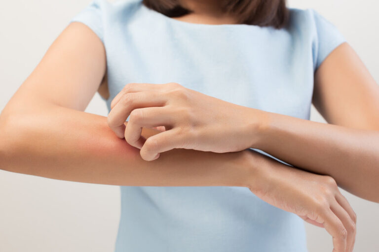 Eczema