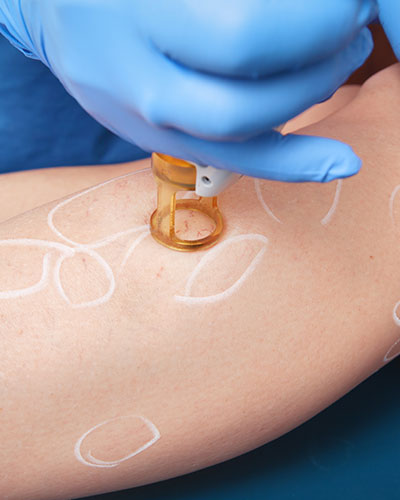 Vein & redness laser
