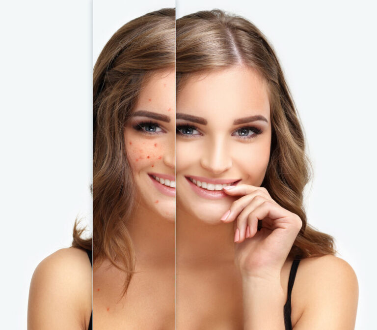 Rosacea