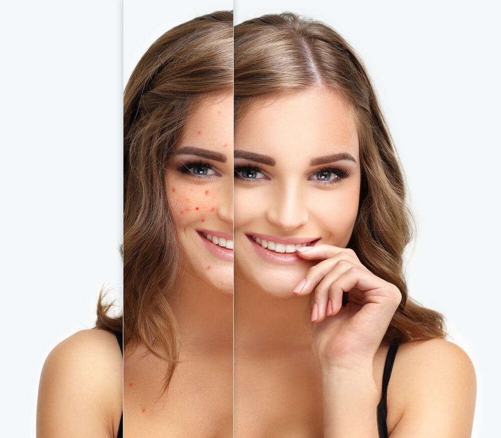 Rosacea