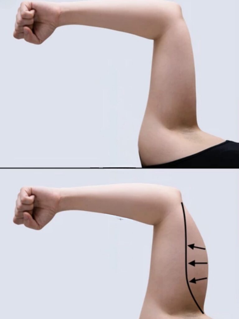 Arm liposuction