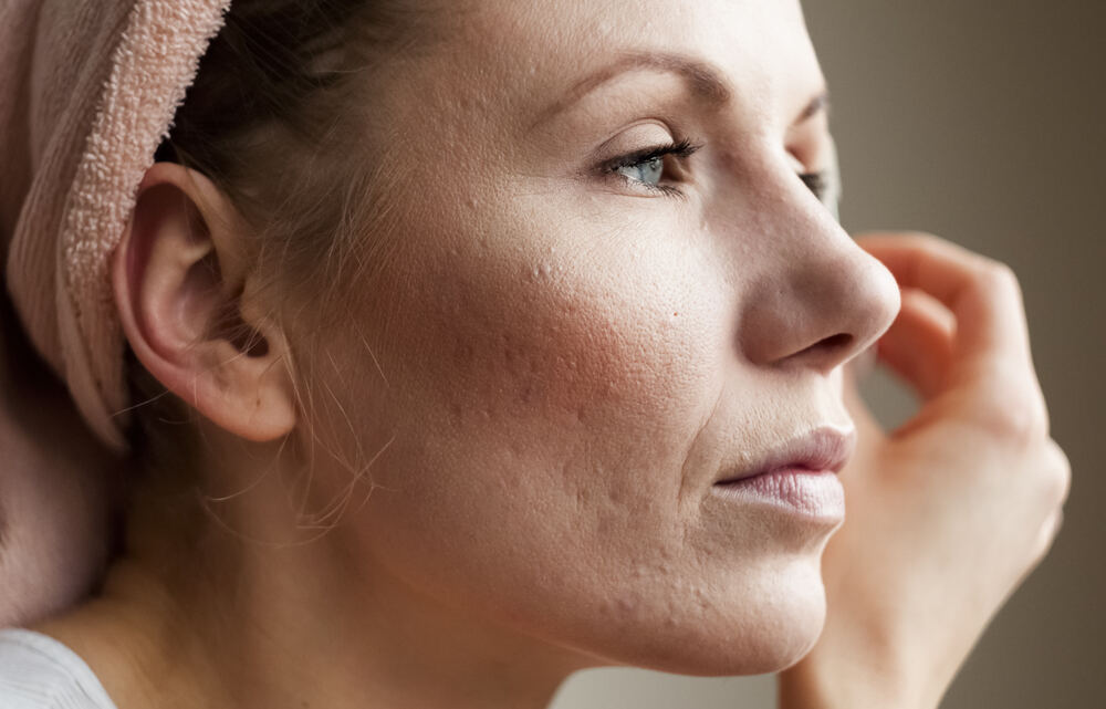 Uneven skin tone