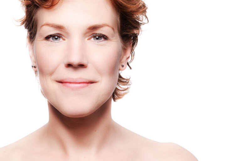 What are age spots and how can they be treated?