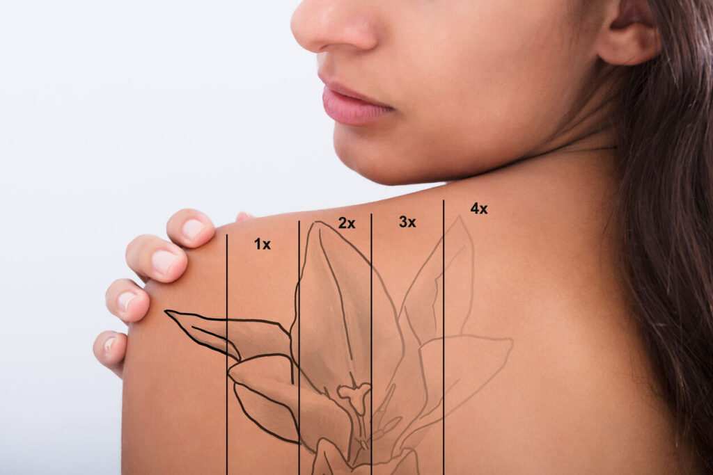 Laser tattoo removal
