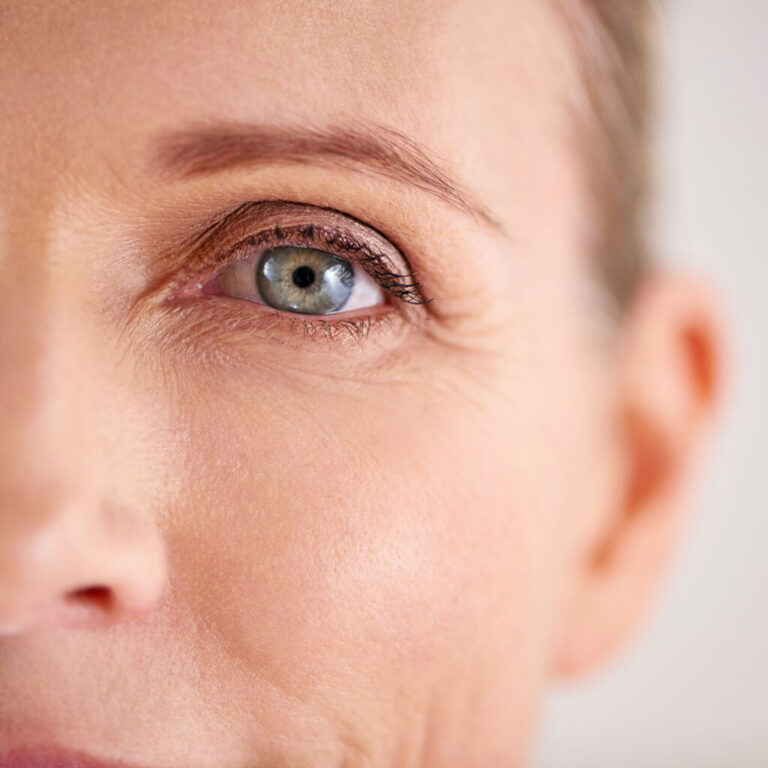 Under-eye bags & dark circles